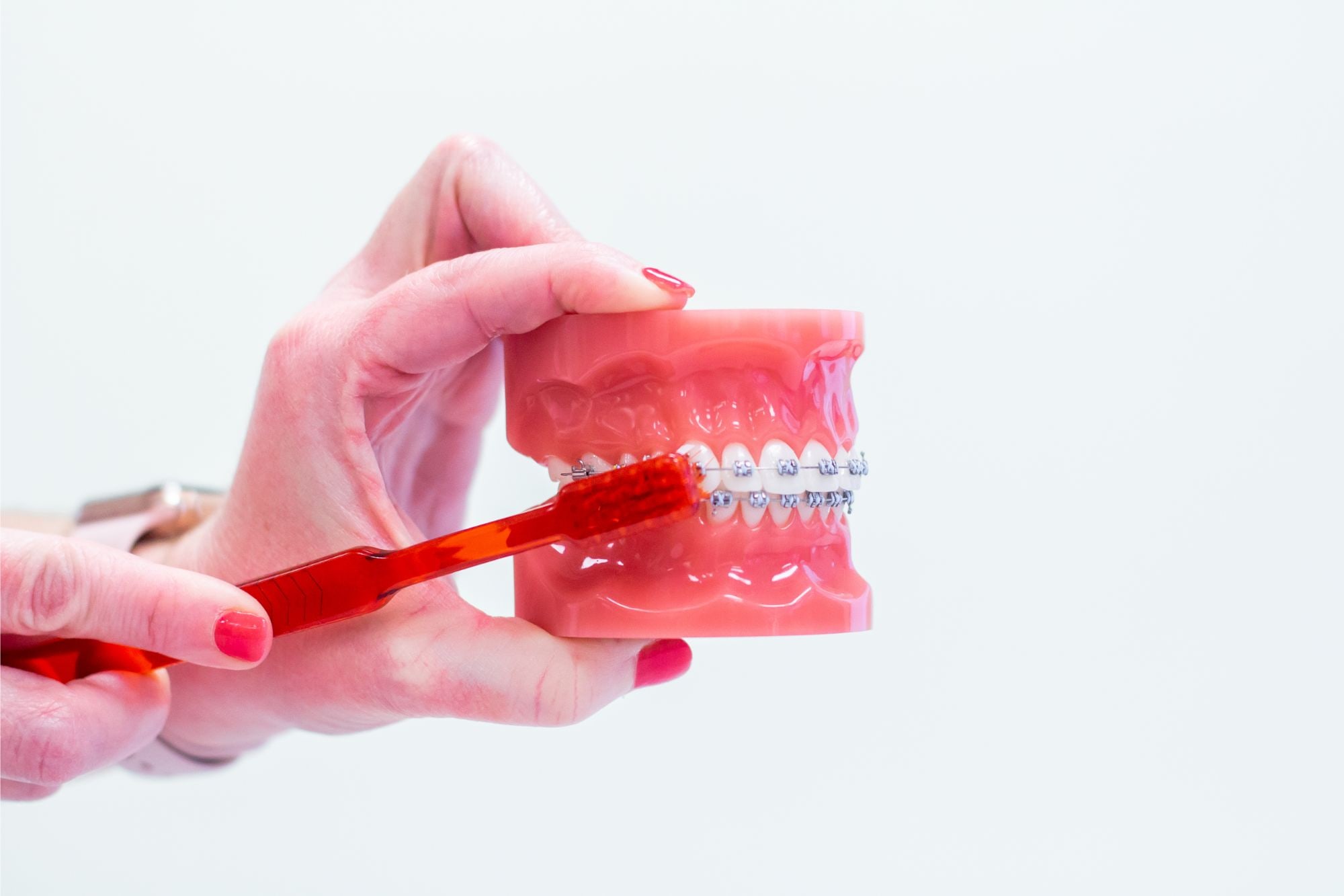 Life with Braces Braces Oxford Designer Smiles by Benton