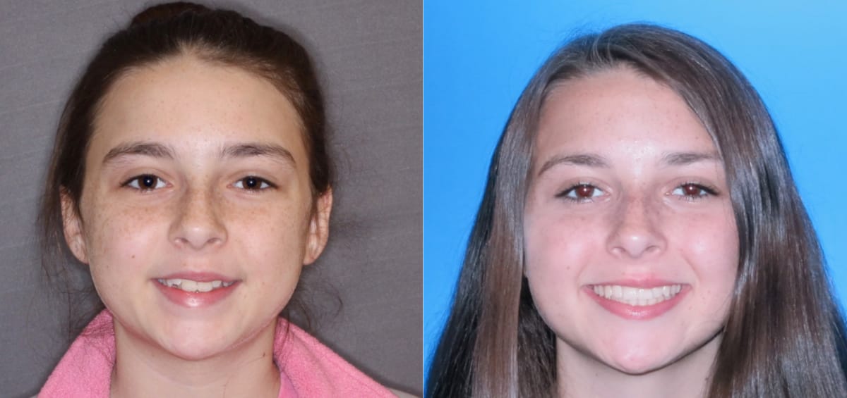 patient-Ashtyn oxford al orthodontics