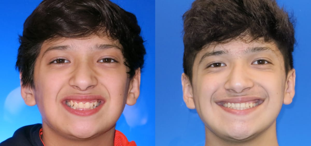 patient-Joallen oxford al orthodontics