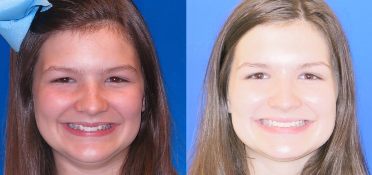 patient-Jules oxford al orthodontics