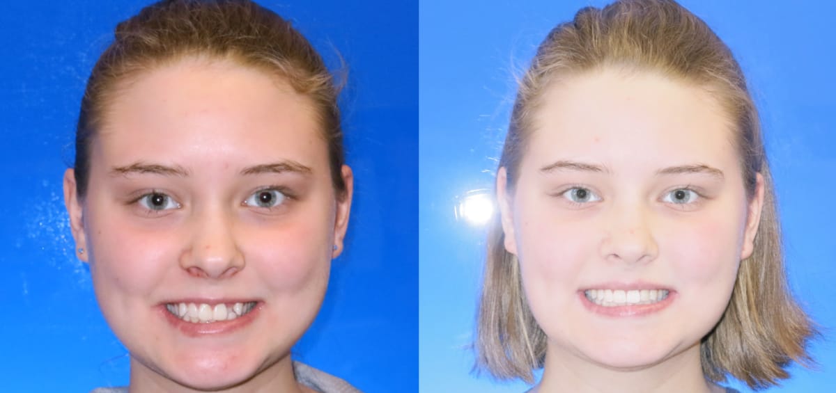 patient-Kourtney oxford al orthodontics