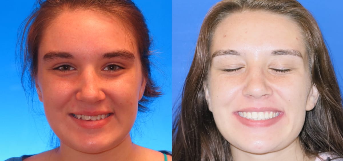 patient-Marissa oxford al orthodontics