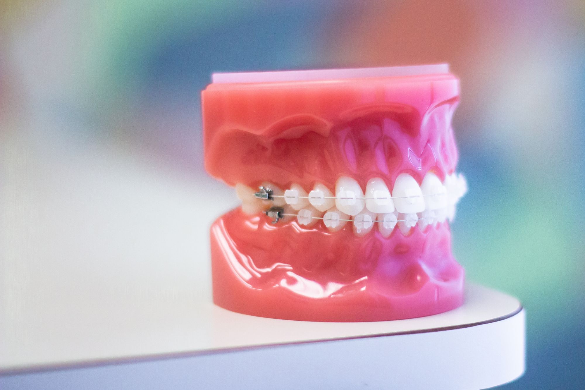 model of clear braces at Moody orthodontist