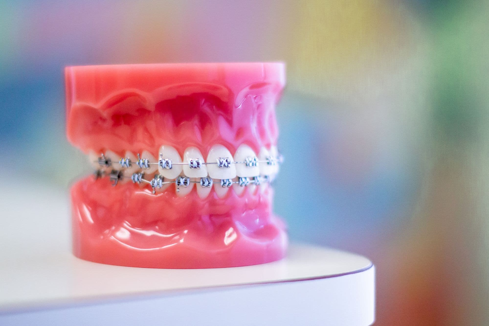 model of metal braces at designer smiles in Moody